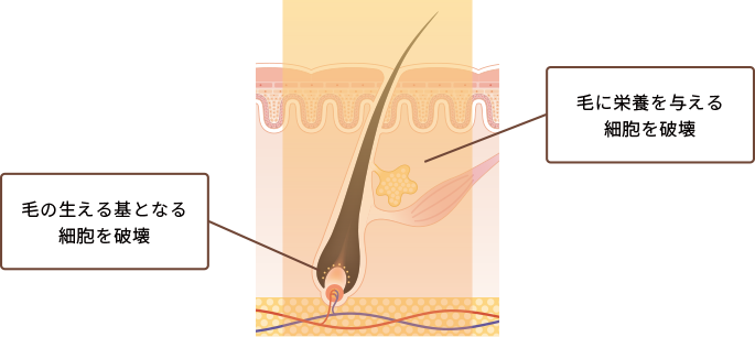 毛の生える基となる細胞を破壊 毛に栄養を与える細胞を破壊