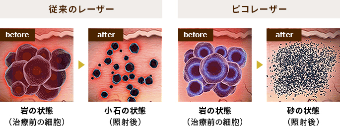 従来のレーザー before 岩の状態（治療前の細胞） after 小石の状態（照射後） ピコレーザー before 岩の状態（治療前の細胞） after 砂の状態（照射後）